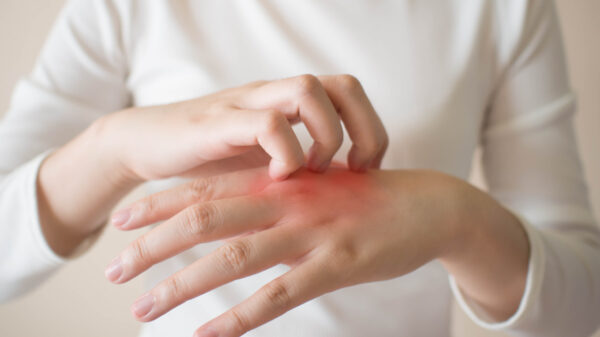 Young woman scratching the itch on her hands redness rash Eczema - Life Pharmacy Blog