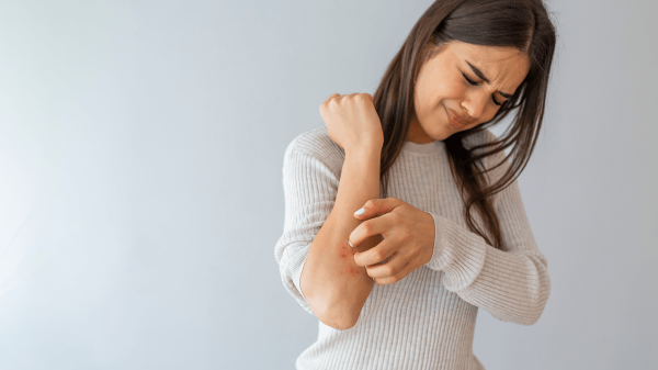 Psoriasis: Causes, Triggers, Treatment